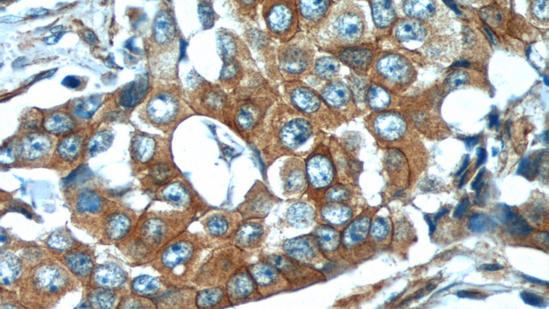 Immunohistochemistry of paraffin-embedded human breast cancer tissue slide using Catalog No:109154(CDH26 Antibody) at dilution of 1:50 (under 40x lens)