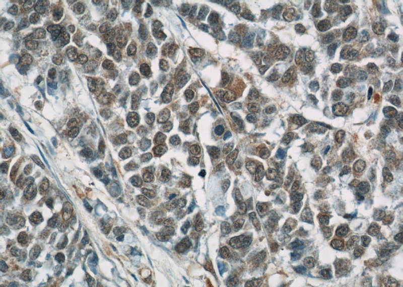 Immunohistochemical of paraffin-embedded human colon cancer using Catalog No:108005(AREG antibody) at dilution of 1:50 (under 40x lens)