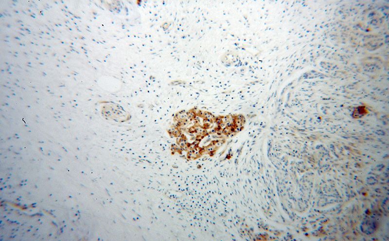 Immunohistochemical of paraffin-embedded human pancreas cancer using Catalog No:116809(VWA1 antibody) at dilution of 1:50 (under 10x lens)