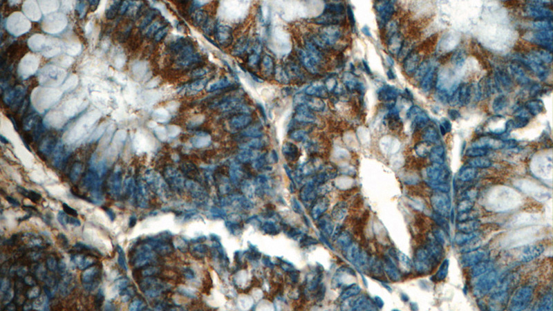 Immunohistochemistry of paraffin-embedded human colon tissue slide using Catalog No:110653(FIBCD1 Antibody) at dilution of 1:50 (under 40x lens)