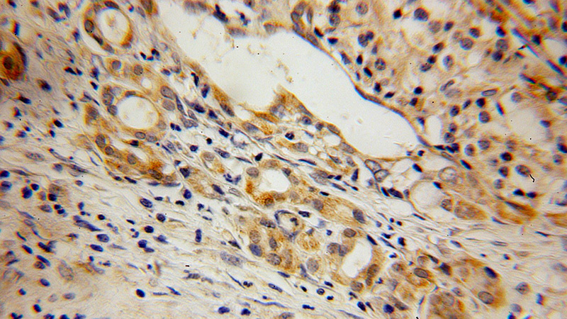 Immunohistochemical of paraffin-embedded human pancreas cancer using Catalog No:110284(ELMOD2 antibody) at dilution of 1:100 (under 40x lens)