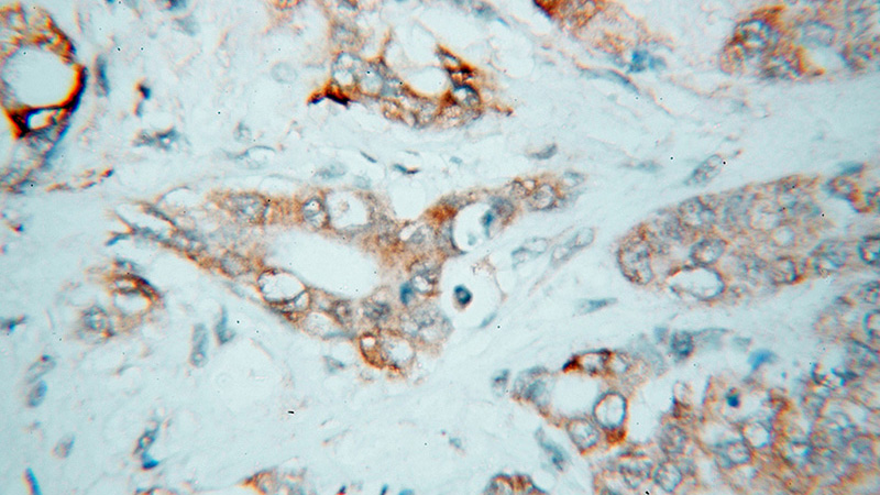 Immunohistochemical of paraffin-embedded human colon cancer using Catalog No:109193(CES2 antibody) at dilution of 1:100 (under 40x lens)
