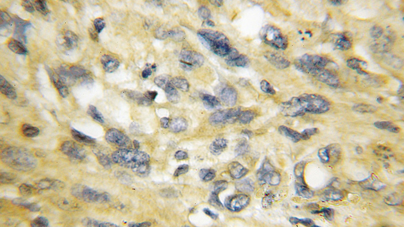 Immunohistochemical of paraffin-embedded human gliomas using Catalog No:115119(SEPT5 antibody) at dilution of 1:50 (under 10x lens)