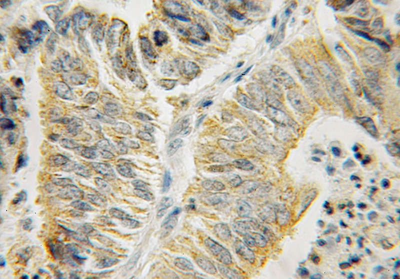 Immunohistochemical of paraffin-embedded human endometrial cancer using Catalog No:111572(HSPA13 antibody) at dilution of 1:50 (under 10x lens)
