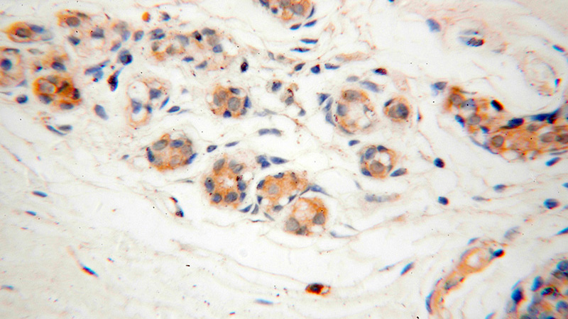 Immunohistochemical of paraffin-embedded human colon cancer using Catalog No:108845(CAPZA2 antibody) at dilution of 1:50 (under 40x lens)