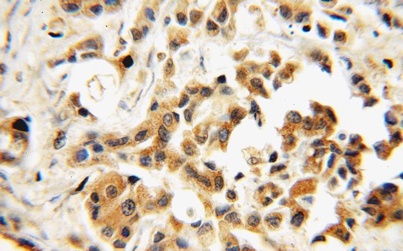 Immunohistochemical of paraffin-embedded human breast cancer using Catalog No:115420(SMAD4 antibody) at dilution of 1:100 (under 40x lens)