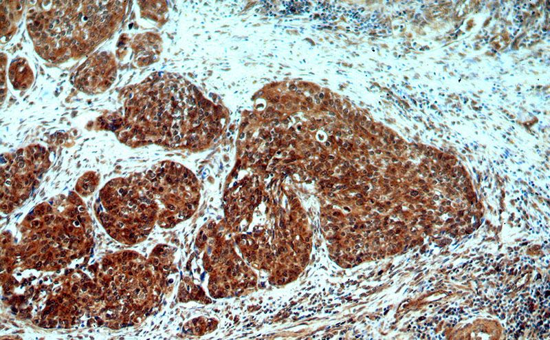 Immunohistochemical of paraffin-embedded human cervical cancer using Catalog No:110079(DNA2 antibody) at dilution of 1:50 (under 10x lens)