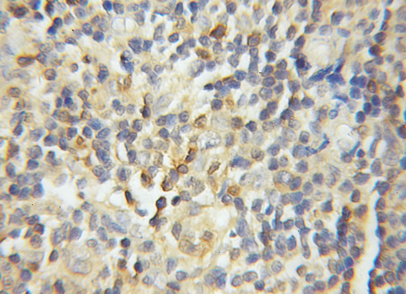 Immunohistochemical of paraffin-embedded human lymphoma using Catalog No:111162(GRAP2 antibody) at dilution of 1:50 (under 10x lens)