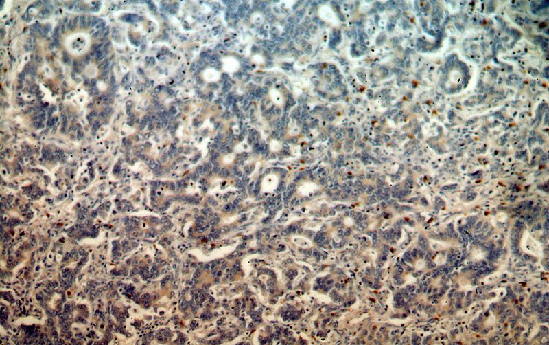 Immunohistochemical of paraffin-embedded human stomach cancer using Catalog No:111637(IHH antibody) at dilution of 1:50 (under 10x lens)