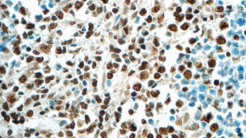 Immunohistochemistry of paraffin-embedded human lymphoma tissue slide using Catalog No:111501(HNRNPA2B1 Antibody) at dilution of 1:50 (under 40x lens)
