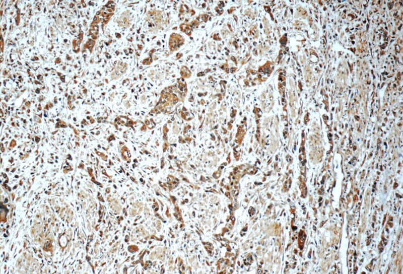 Immunohistochemistry of paraffin-embedded human stomach cancer tissue slide using Catalog No:108090(ANXA10 Antibody) at dilution of 1:100 (under 10x lens)