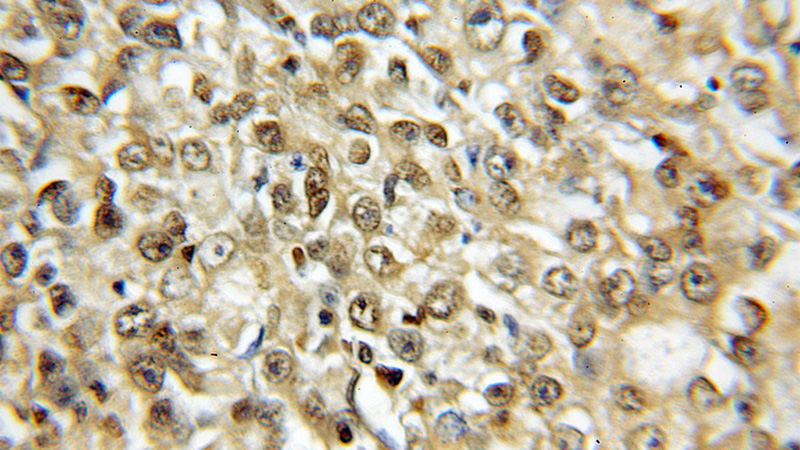 Immunohistochemical of paraffin-embedded human lung cancer using Catalog No:114376(PSMA6 antibody) at dilution of 1:50 (under 10x lens)