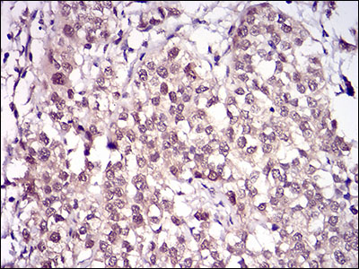 Immunohistochemical analysis of paraffin-embedded bladder cancer tissues using RANBP9 mouse mAb with DAB staining.