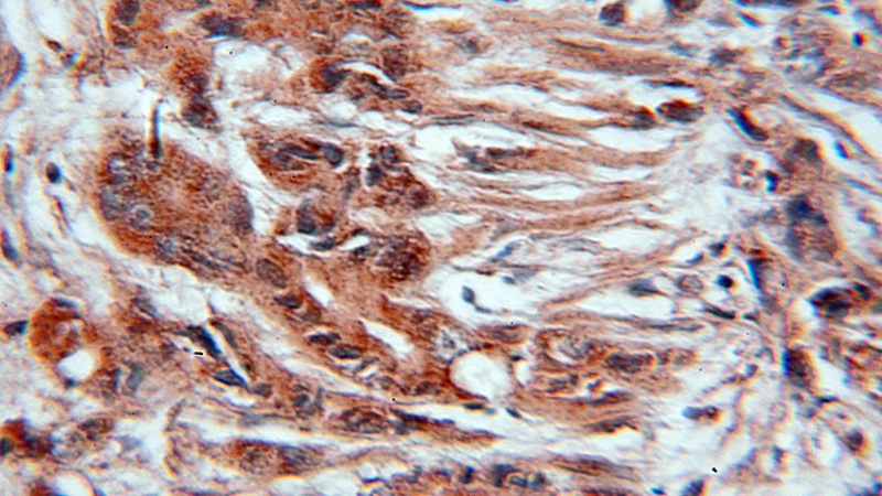 Immunohistochemical of paraffin-embedded human prostate cancer using Catalog No:109743(CUL3 antibody) at dilution of 1:100 (under 10x lens)