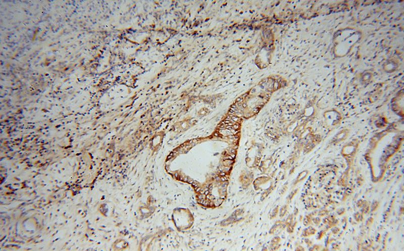 Immunohistochemical of paraffin-embedded human pancreas cancer using Catalog No:114983(SCAMP2 antibody) at dilution of 1:100 (under 10x lens)