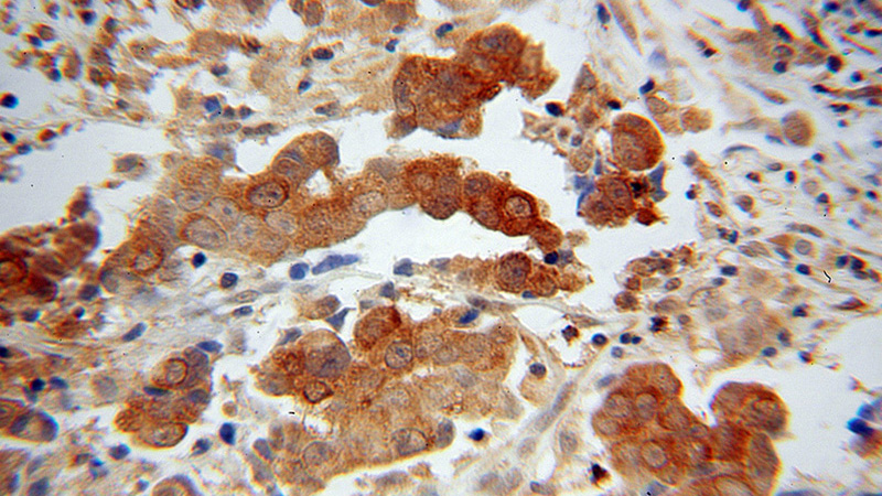Immunohistochemical of paraffin-embedded human prostate cancer using Catalog No:116435(TSLP antibody) at dilution of 1:50 (under 40x lens)