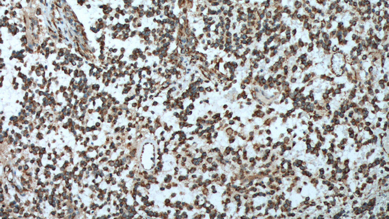 Immunohistochemistry of paraffin-embedded human gliomas tissue slide using (Nestin Antibody) at dilution of 1:200 (under 10x lens).