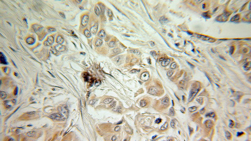 Immunohistochemical of paraffin-embedded human ovary tumor using Catalog No:109367(COG1 antibody) at dilution of 1:100 (under 10x lens)