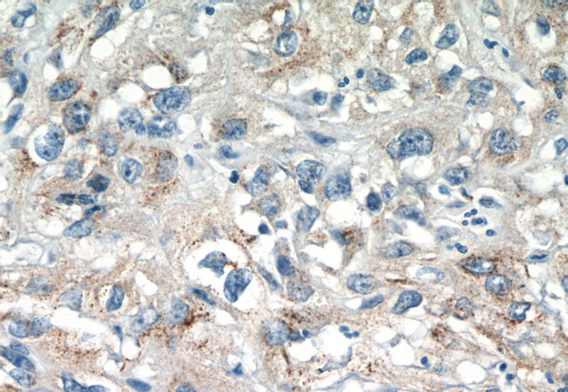 Immunohistochemistry of paraffin-embedded human cervical cancer tissue slide using Catalog No:115756(SYAP1 Antibody) at dilution of 1:50 (under 40x lens)