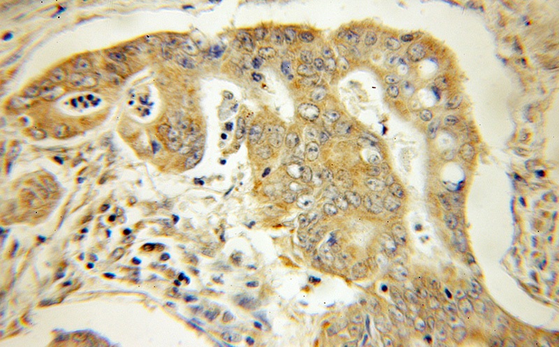 Immunohistochemical of paraffin-embedded human colon cancer using Catalog No:115089(SEC61G antibody) at dilution of 1:50 (under 10x lens)