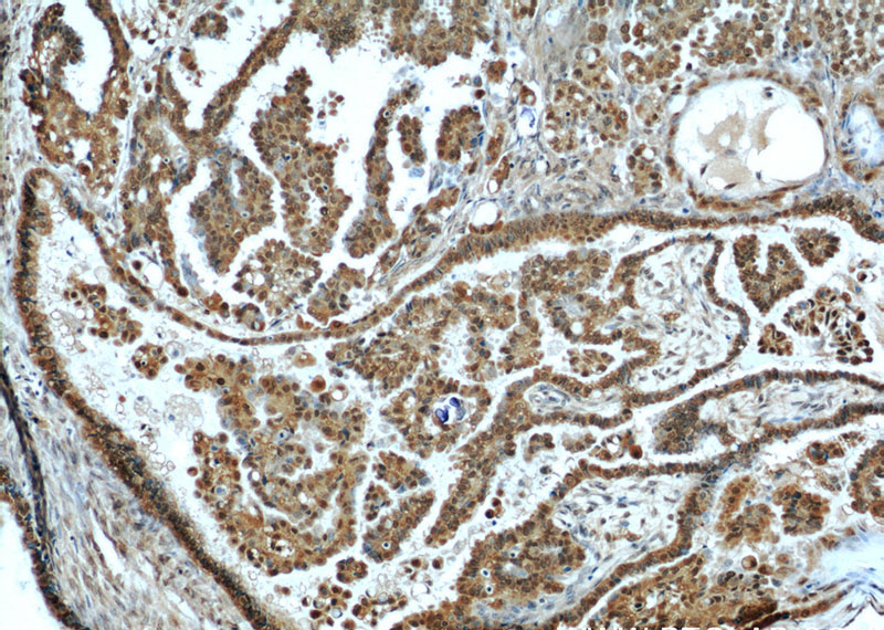 Immunohistochemical of paraffin-embedded human ovary tumor using Catalog No:108091(ANXA11 antibody) at dilution of 1:50 (under 10x lens)
