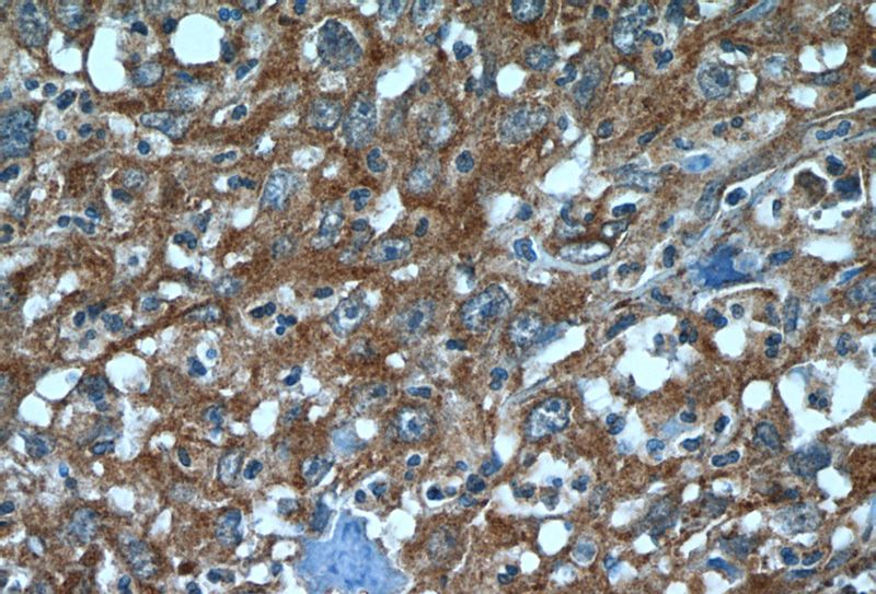 Immunohistochemistry of paraffin-embedded human cervical cancer tissue slide using Catalog No:108286(ATF6 Antibody) at dilution of 1:50 (under 40x lens)