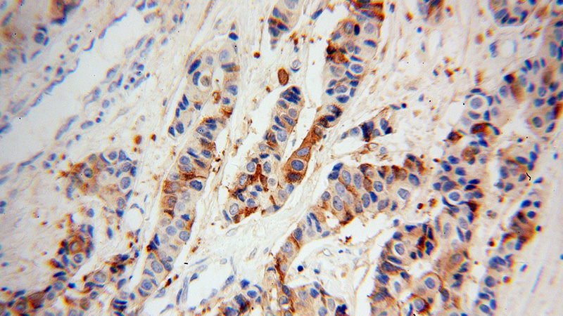 Immunohistochemical of paraffin-embedded human breast cancer using Catalog No:117058(AZGP1 antibody) at dilution of 1:100 (under 40x lens)