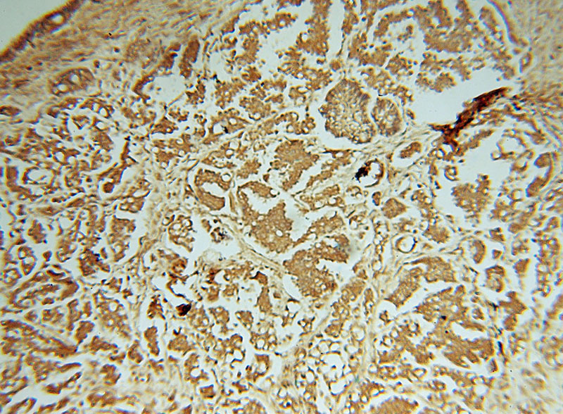 Immunohistochemical of paraffin-embedded human ovary tumor using Catalog No:113893(PIGK antibody) at dilution of 1:50 (under 10x lens)