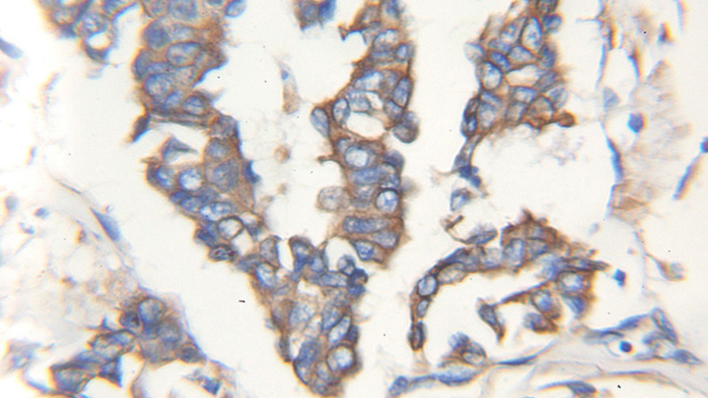 Immunohistochemical of paraffin-embedded human breast cancer using Catalog No:115675(STC2 antibody) at dilution of 1:100 (under 10x lens)