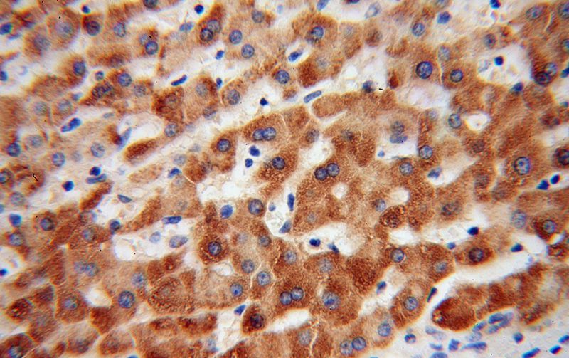 Immunohistochemical of paraffin-embedded human liver cancer using Catalog No:112535(MGAT1 antibody) at dilution of 1:100 (under 40x lens)