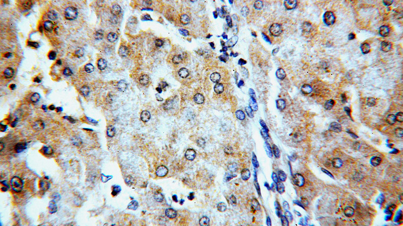 Immunohistochemical of paraffin-embedded human hepatocirrhosis using Catalog No:107957(AOX1 antibody) at dilution of 1:100 (under 40x lens)