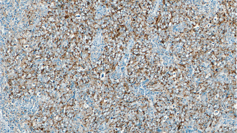Immunohistochemistry of paraffin-embedded human breast cancer tissue slide using Catalog No:115493(SOD2 Antibody) at dilution of 1:50 (under 10x lens)