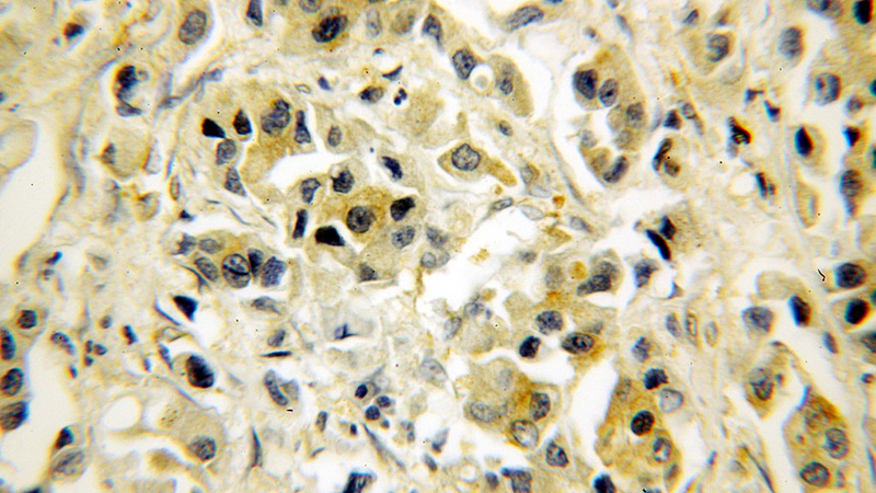 Immunohistochemical of paraffin-embedded human breast cancer using Catalog No:113559(p65 antibody) at dilution of 1:50 (under 40x lens)