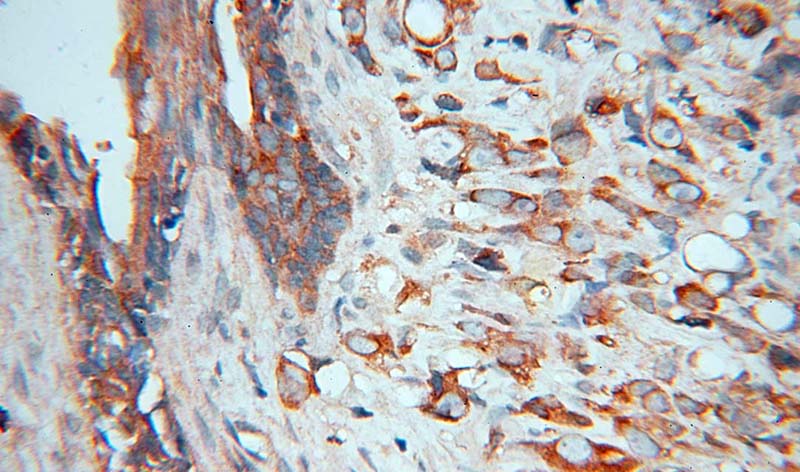 Immunohistochemical of paraffin-embedded human prostate cancer using Catalog No:113500(PAK4 antibody) at dilution of 1:100 (under 40x lens)