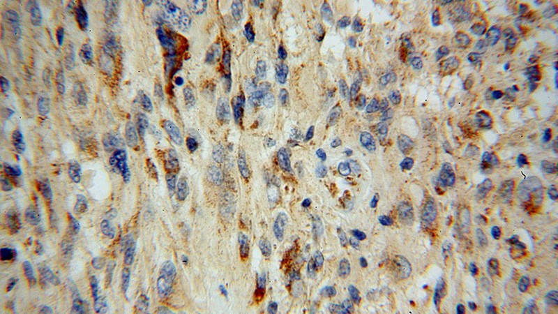 Immunohistochemical of paraffin-embedded human gliomas using Catalog No:115545(Spartin, SPG20 antibody) at dilution of 1:100 (under 40x lens)