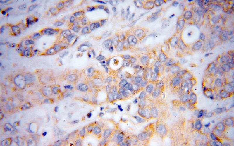 Immunohistochemical of paraffin-embedded human colon cancer using Catalog No:110041(DTYMK antibody) at dilution of 1:100 (under 40x lens)