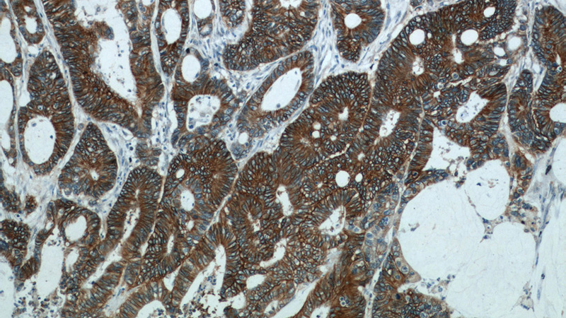 Immunohistochemistry of paraffin-embedded human colon cancer tissue slide using (CDH17 Antibody) at dilution of 1:300 (under 10x lens).