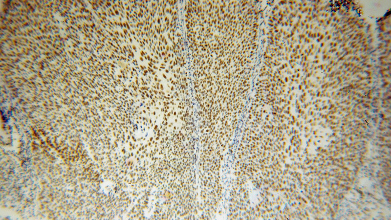Immunohistochemical of paraffin-embedded human cervical cancer using Catalog No:111504(HNRNPD antibody) at dilution of 1:100 (under 10x lens)