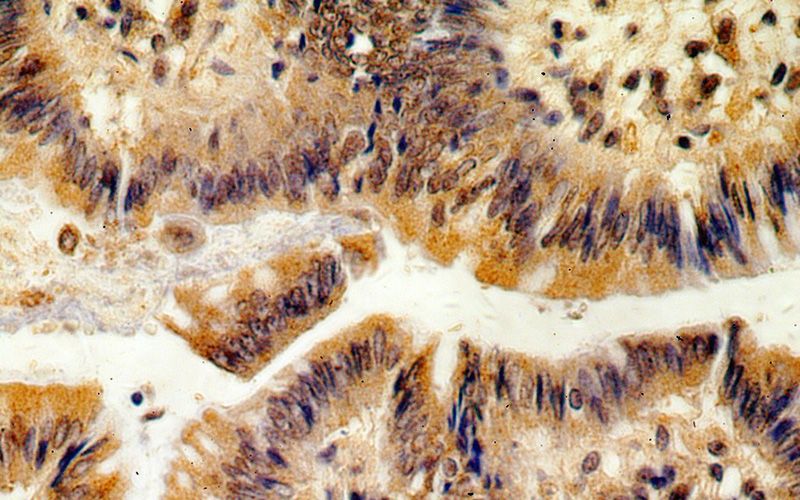 Immunohistochemical of paraffin-embedded human colon using Catalog No:114604(RBM19 antibody) at dilution of 1:50 (under 40x lens)