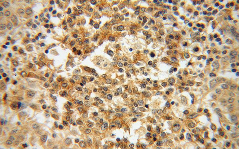 Immunohistochemical of paraffin-embedded human breast cancer using Catalog No:110837(LGALS4,GAL4 antibody) at dilution of 1:50 (under 40x lens)
