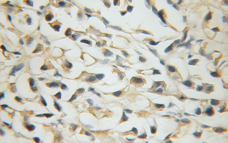Immunohistochemical of paraffin-embedded human prostate cancer using Catalog No:115373(SLC38A1 antibody) at dilution of 1:50 (under 40x lens)