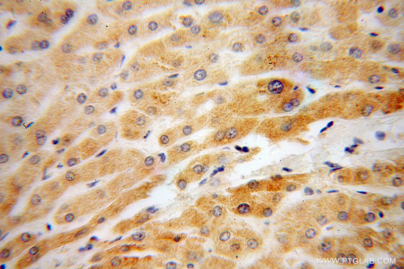Immunohistochemical of paraffin-embedded human liver cancer using Catalog No:114563(RBP5 antibody) at dilution of 1:50 (under 40x lens)