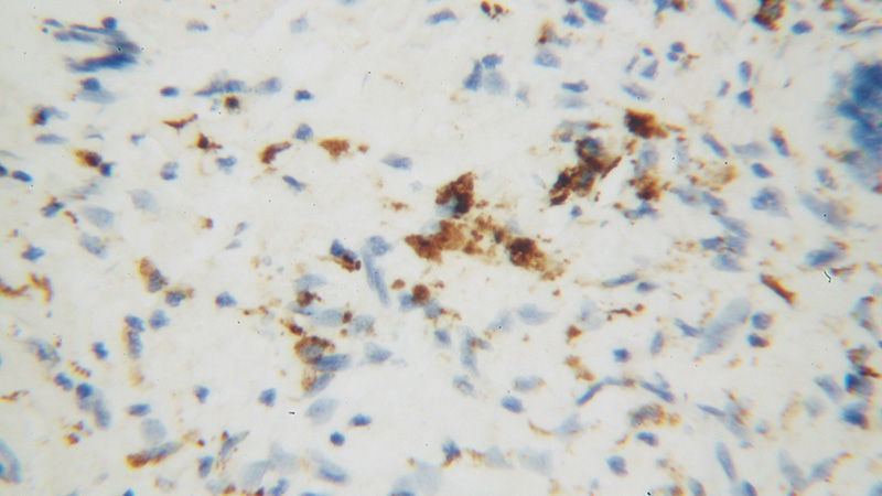 Immunohistochemical of paraffin-embedded human skin cancer using Catalog No:112820(MRPL27 antibody) at dilution of 1:50 (under 40x lens)