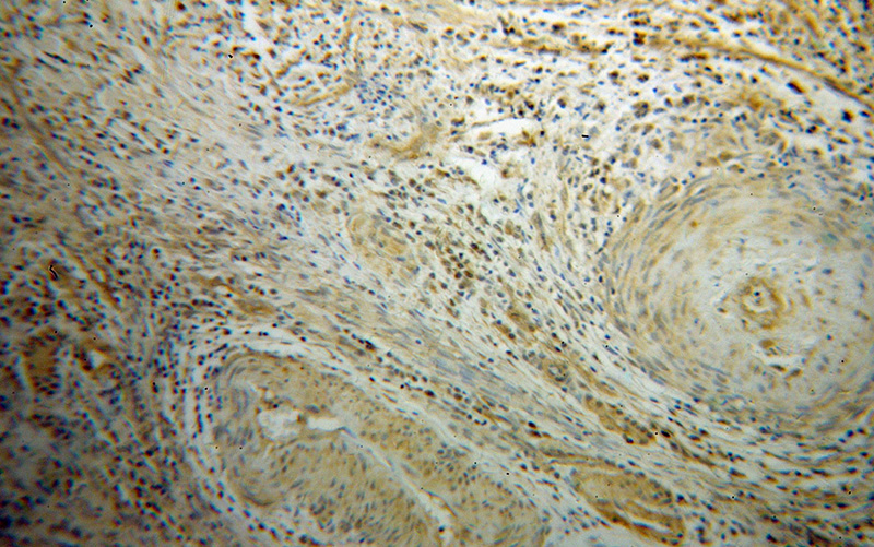 Immunohistochemical of paraffin-embedded human cervical cancer using Catalog No:114108(PPP3CA antibody) at dilution of 1:100 (under 10x lens)