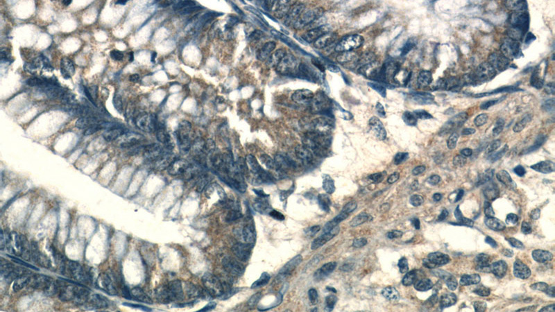 Immunohistochemical of paraffin-embedded human colon using Catalog No:108730(C4orf14 antibody) at dilution of 1:100 (under 40x lens)
