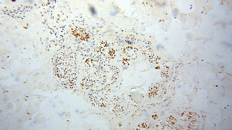 Immunohistochemical of paraffin-embedded human breast cancer using Catalog No:116875(XRCC4 antibody) at dilution of 1:100 (under 10x lens)