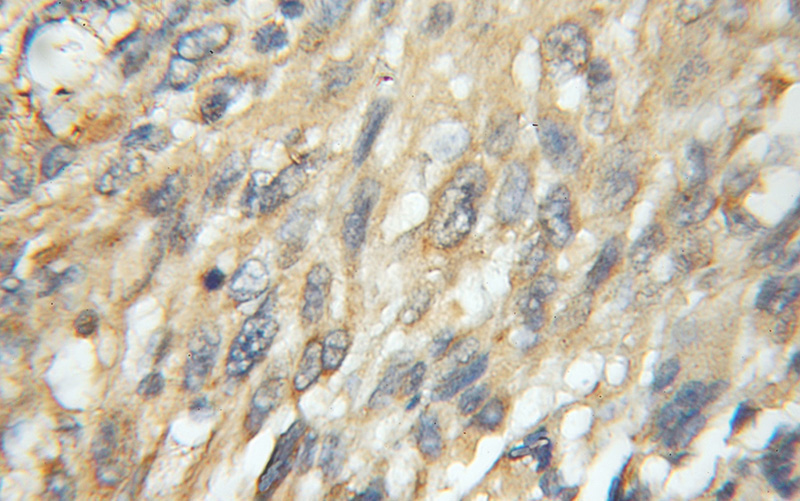Immunohistochemical of paraffin-embedded human gliomas using Catalog No:108108(AZIN1 antibody) at dilution of 1:50 (under 10x lens)