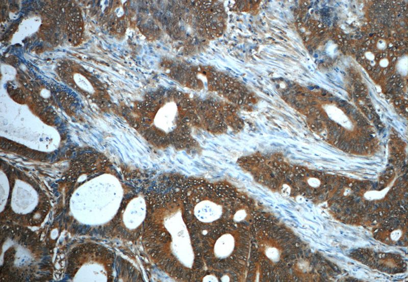 Immunohistochemistry of paraffin-embedded human colon cancer slide using Catalog No:113844(PRKACA Antibody) at dilution of 1:50