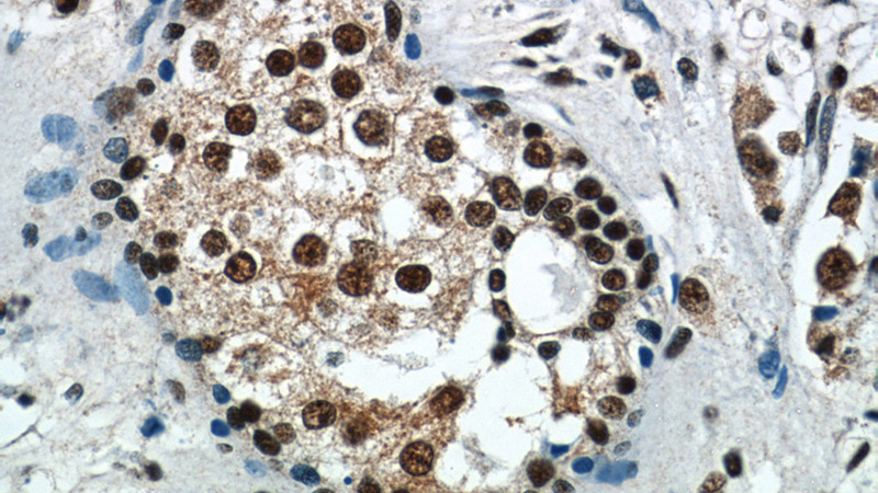 Immunohistochemistry of paraffin-embedded human breast cancer tissue slide using Catalog No:111828(IRAK1 Antibody) at dilution of 1:50 (under 40x lens)