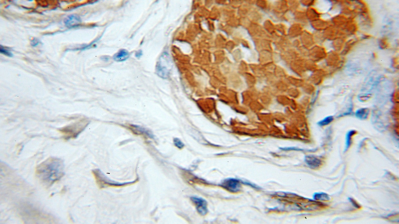 Immunohistochemical of paraffin-embedded human colon cancer using Catalog No:107883(GFER antibody) at dilution of 1:100 (under 10x lens)